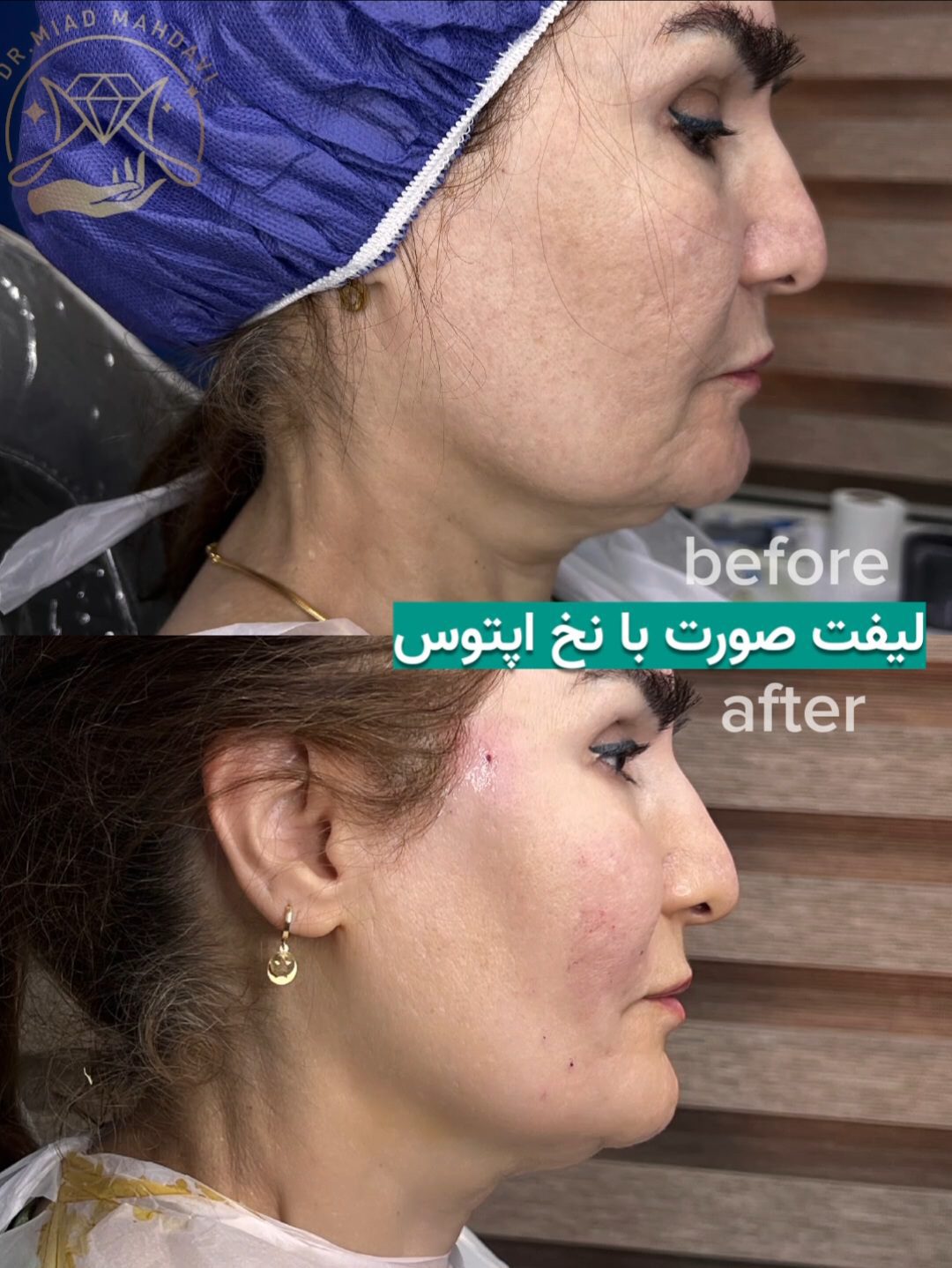 لیفت با نخ آپتوس چیست؟+قیمت و ماندگاری و انواع نخ آپتوس 2 لیفت با نخ اپتوس | دکتر میعاد مهدوی