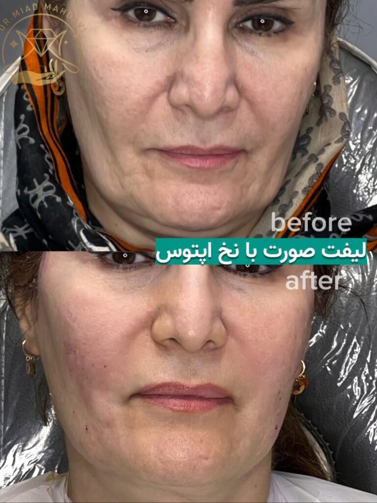 لیفت با نخ آپتوس توسط دکتر میعاد مهدوی | کلینیک زیبایی اندرزگو