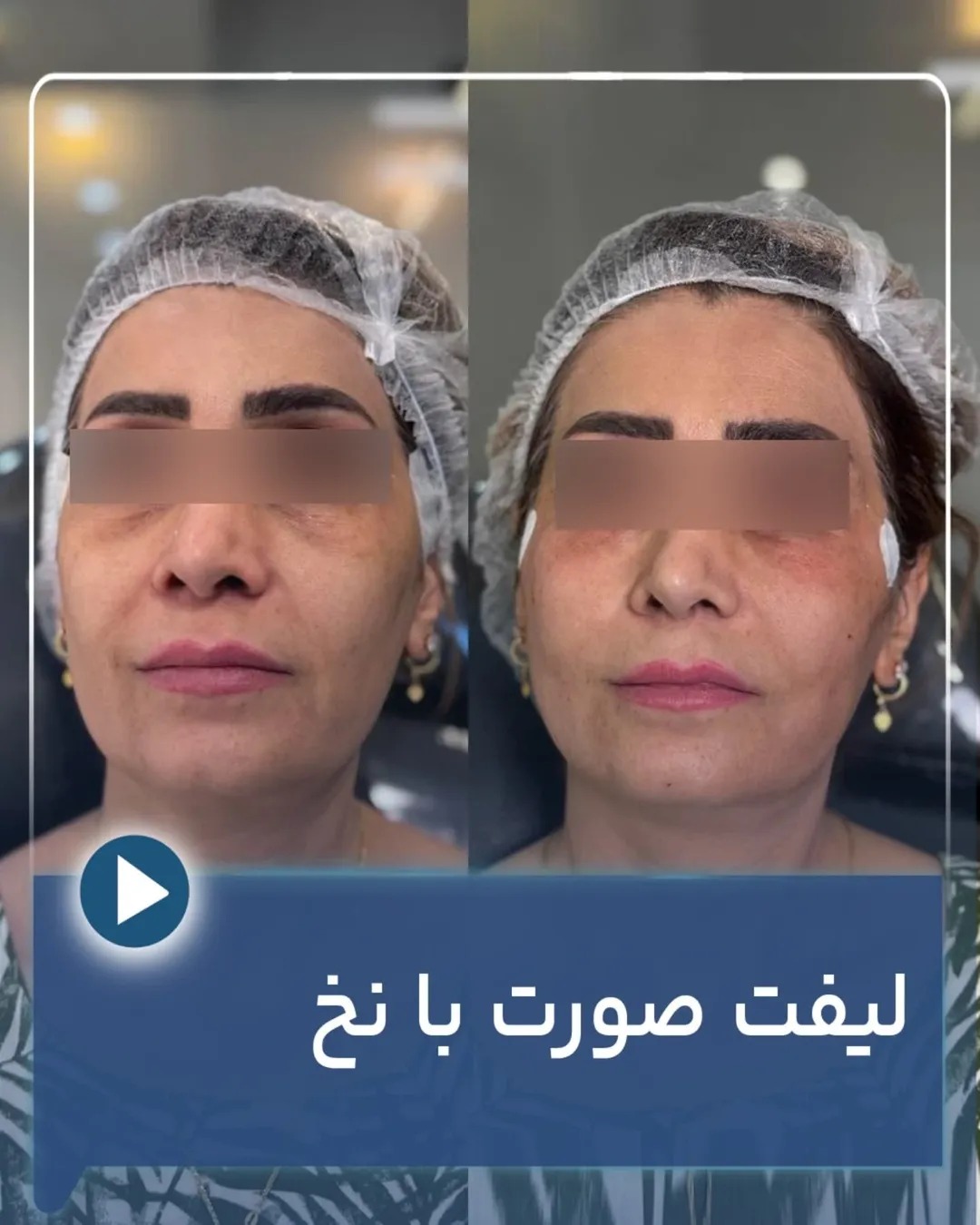 عکس لیفت صورت با نخ | دکتر میعاد مهدوی