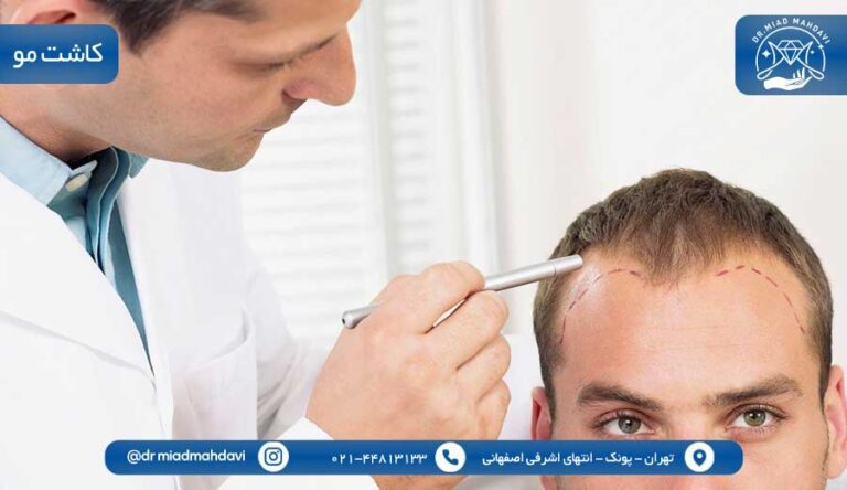 بهترین پزشک پوست مو غرب تهران|کاشت مو|دکتر میعاد مهدوی