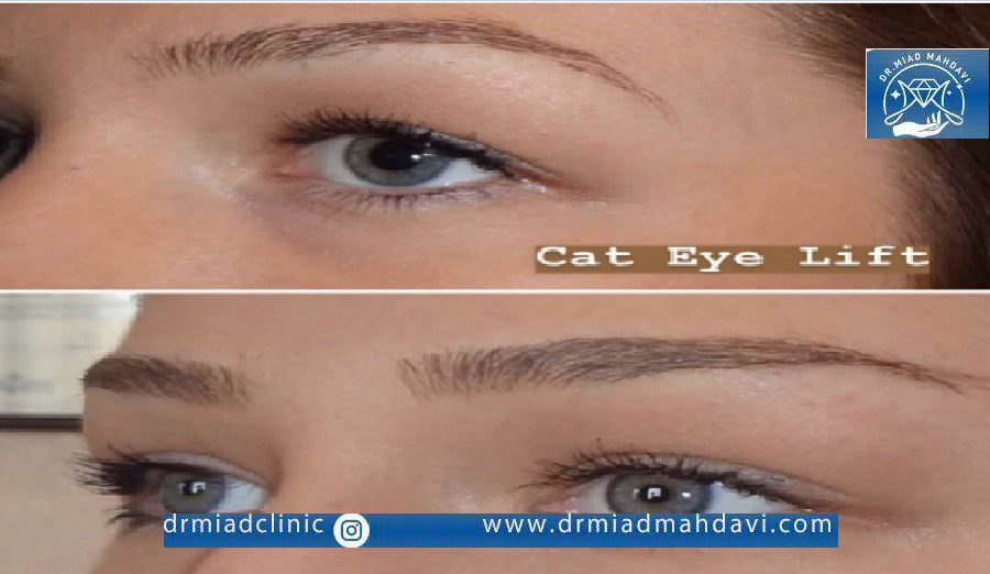 لیفت چشم گربه ای در کلینیک دکتر مهدوی