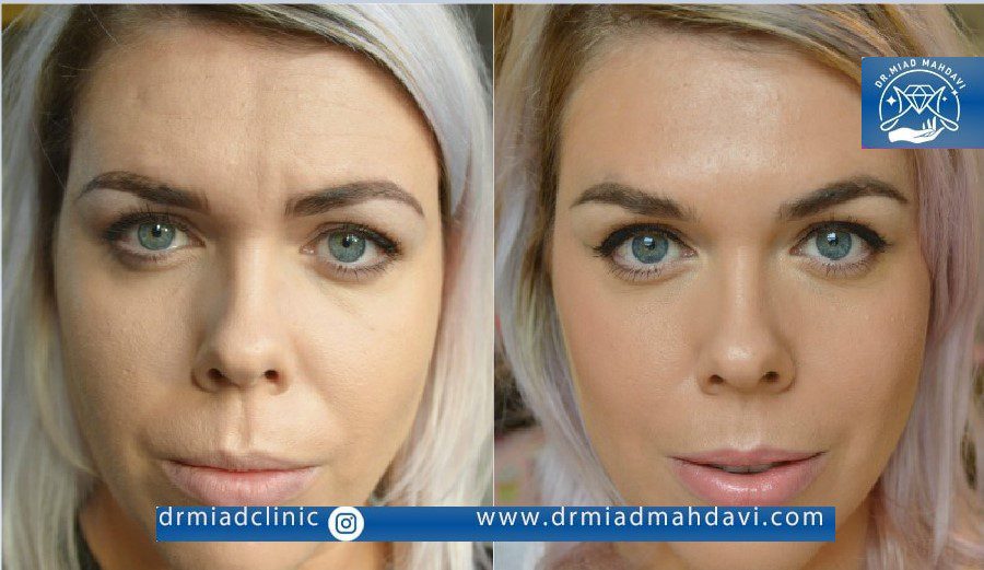 عکس قبل و بعد بوتاکس پیشانی