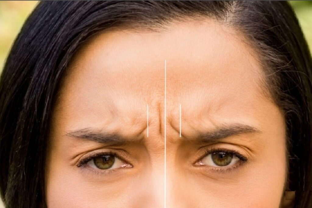 بوتاکس خط اخم