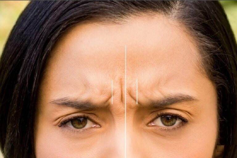 بوتاکس خط اخم