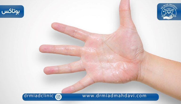 رهایی از تعریق کف دست