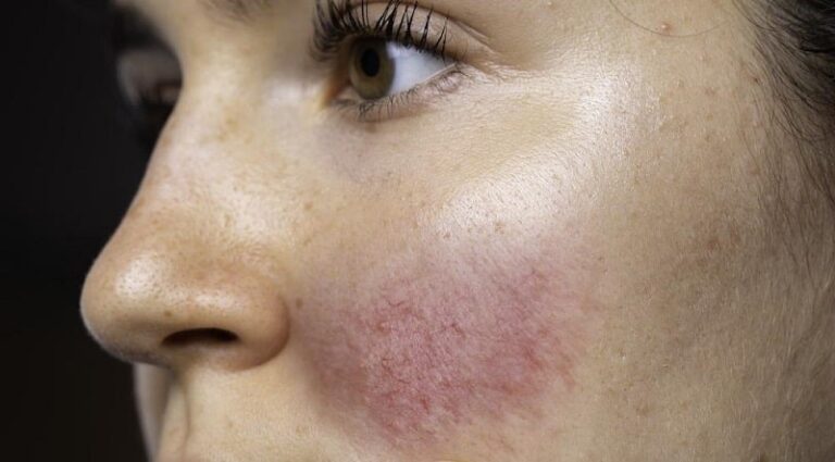 عوارض بوتاکس