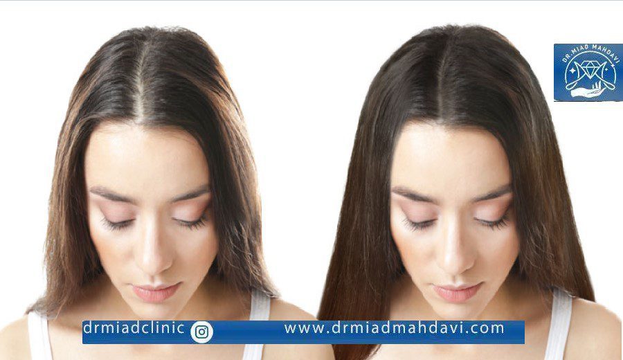 اثر بخشی مزو تراپی مو در چند جلسه