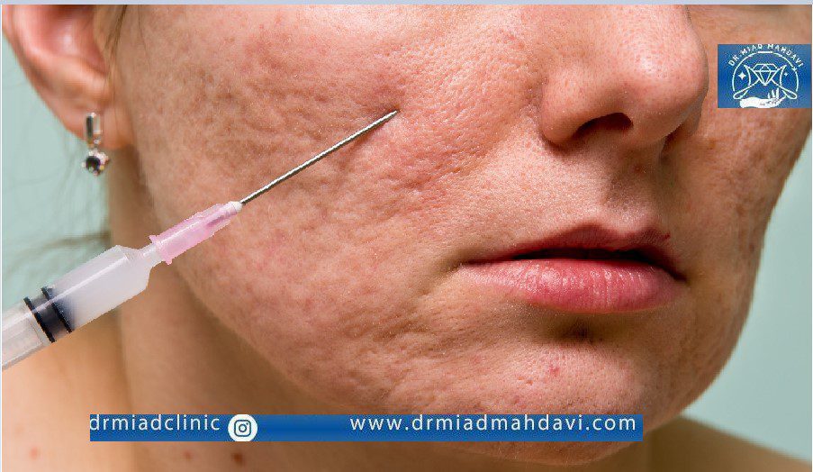 نحوه انجام سابسیژن