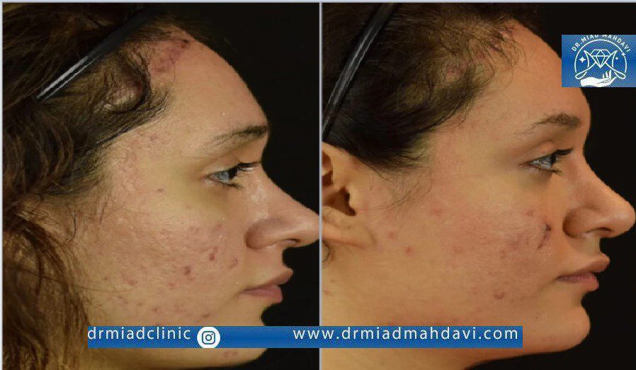 عکس مزوتراپی لک صورت