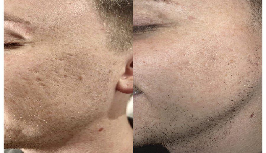 mesotherapy d