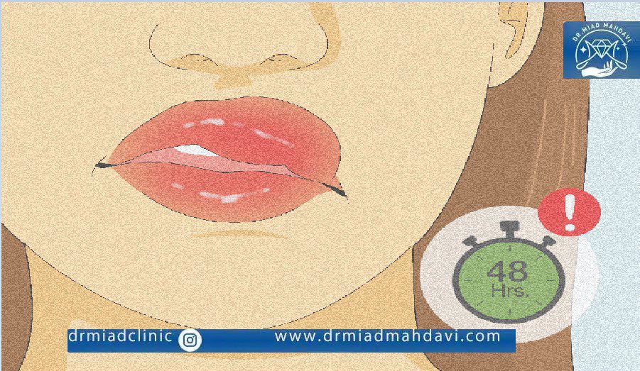 خالی کردن ژل لب