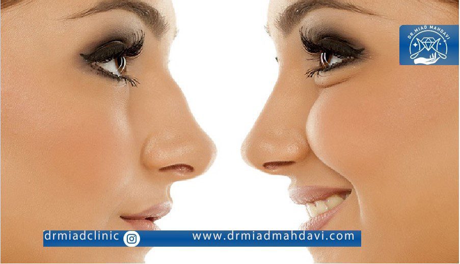 نتیجه اندولیفت کردن بینی و رفع نقص آن