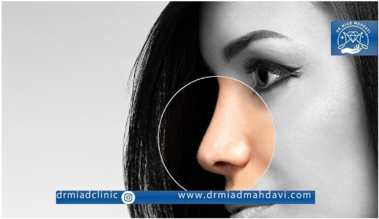 اندولیفت بینی در کلینیک زیبایی دکتر میعاد مهدوی