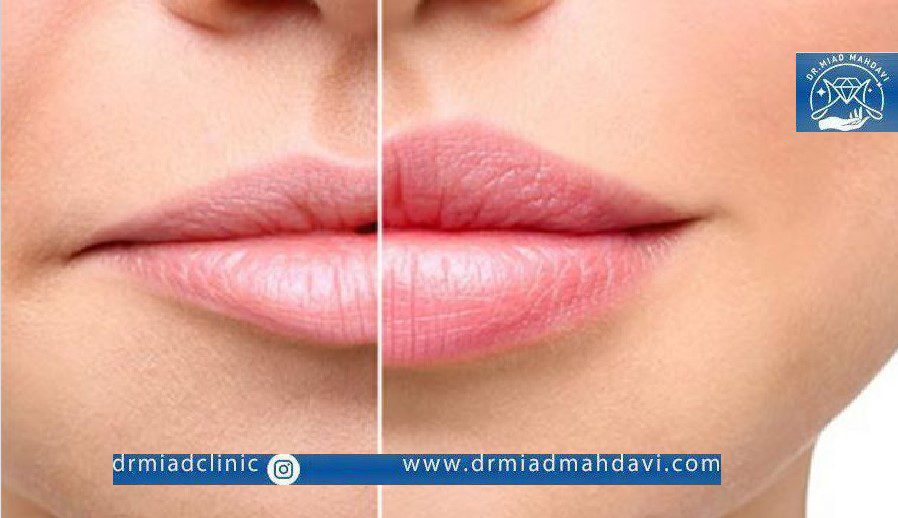 عکس ژل روسی قبل و بعد از تزریق