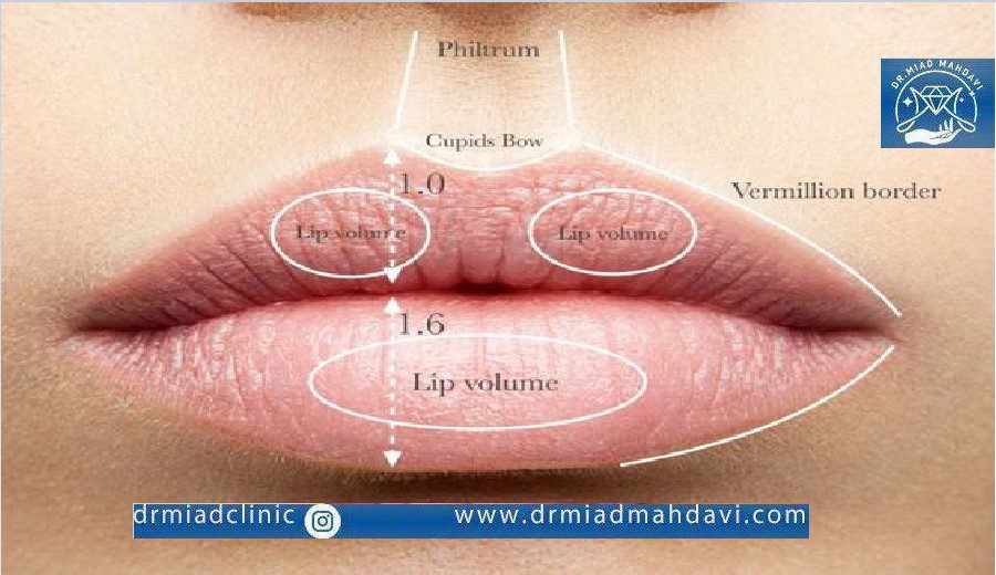 نحوه تزریق ژل لب روسی به نقاط مختلف