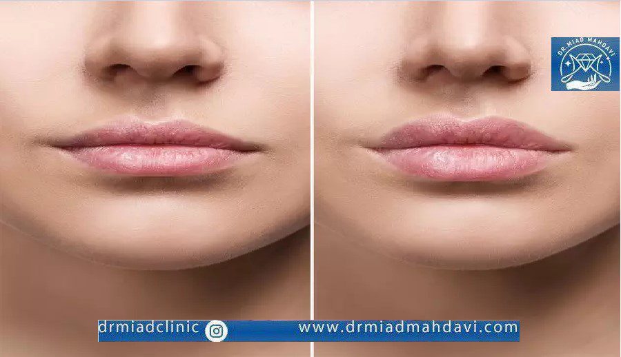 تزریق ژل و فیلر روسی به صورت طبیعی و نچرال