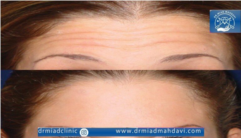 اندولیفت پیشانی