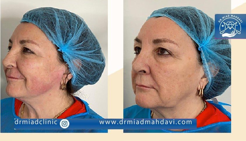 نتیجه لیفت صورت و جوان سازی بعد از اندولیفت در کلینیک دکتر میعاد مهدوی