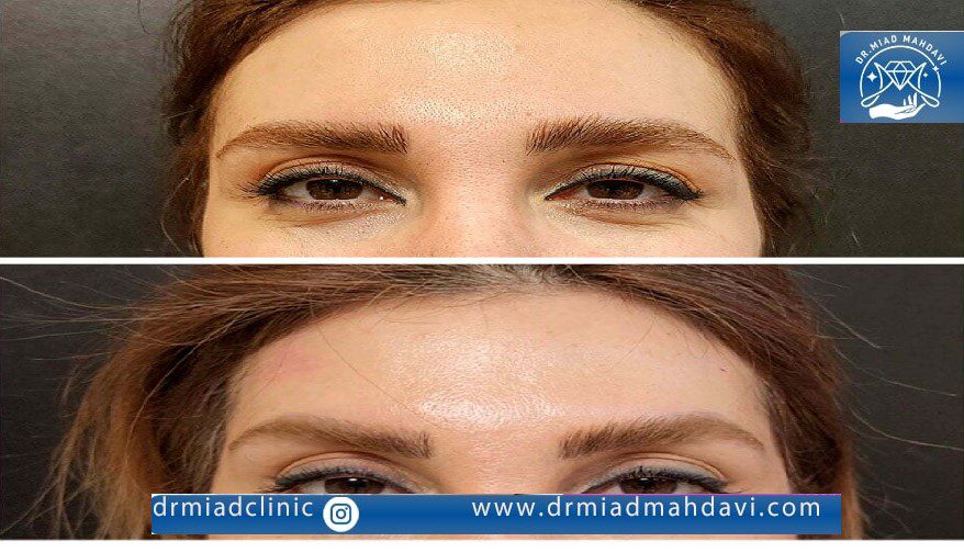 تاثیر فوق العاده اندولیفت پیشانی روی لیفت کردن شقیقه و جوان سازی