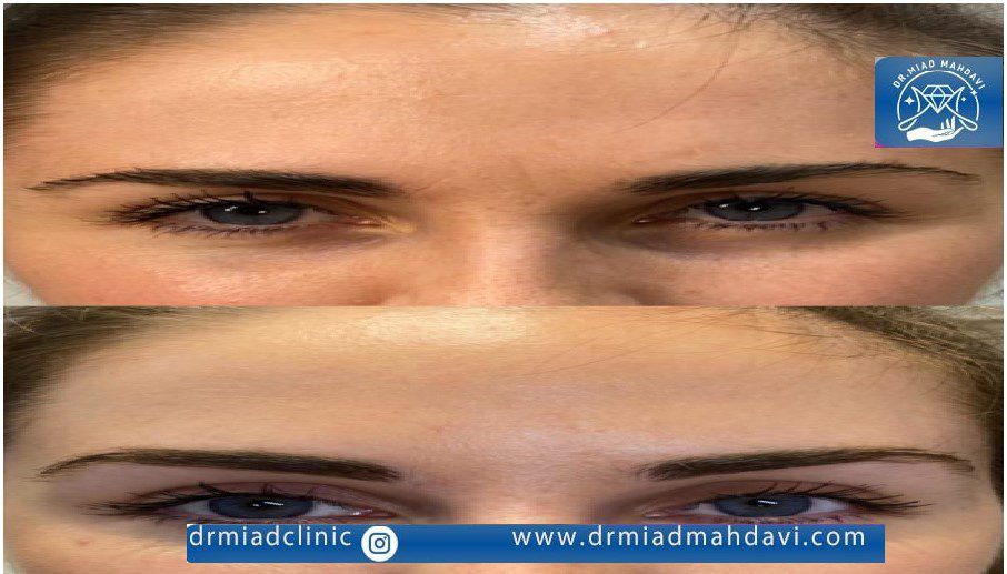 انجام اندولیفت پیشانی و لیفت شقیقه با بهترین متخصص در تهران