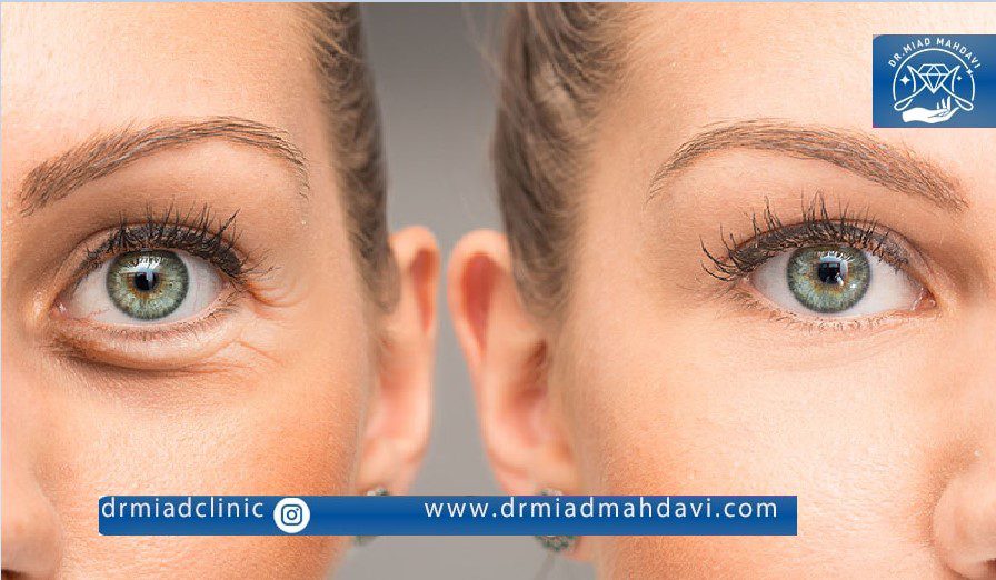 نرخ تزریق فیلر زیر چشم در سال 1403