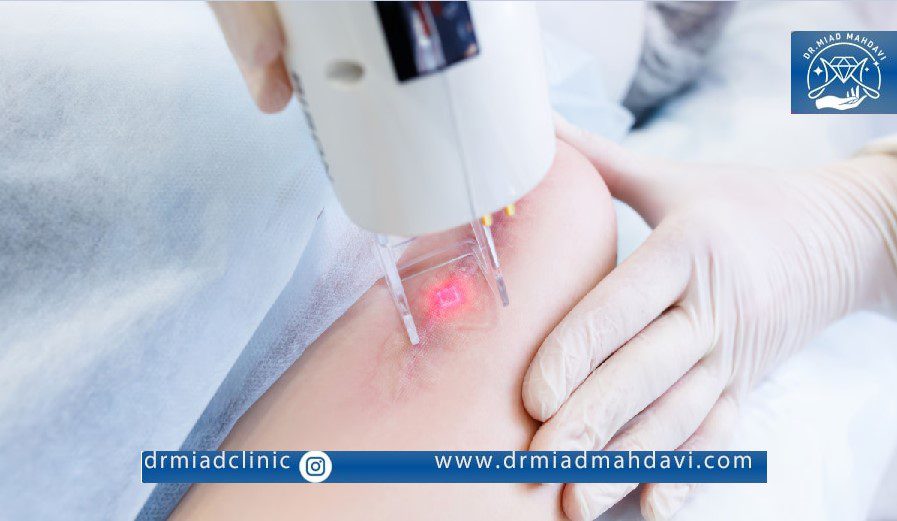 مقایسه و بررسی دستگاه های لیزر رولی و شاتی