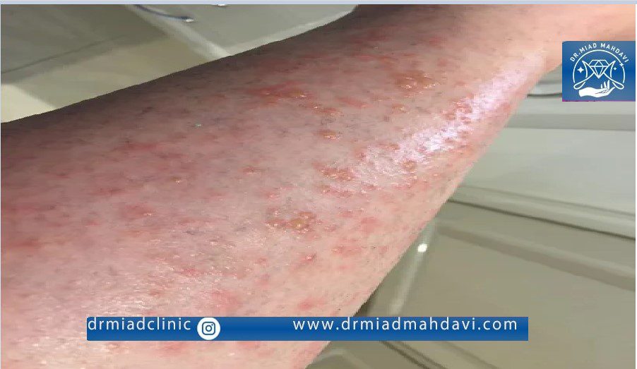 عوارض لیزر موی زائد در مراکز نامعتبر