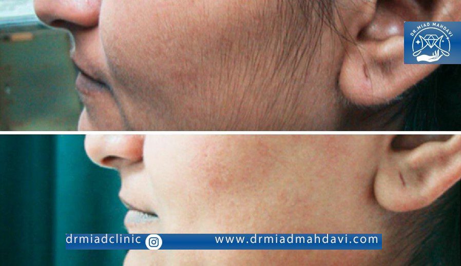 نتیجه لیزر موی زائد صورت در کلینیک دکتر مهدوی
