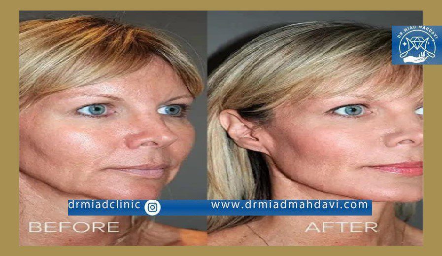 نتیجه لیفت صورت با نخ در کلینیک دکتر میعاد مهدوی