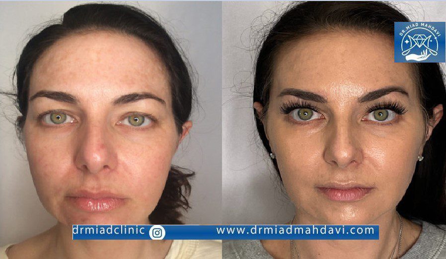 تاثیر بوتاکس روی جوان سازی پوست