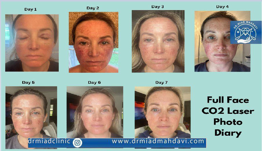 مراحل درمان لیزر co2