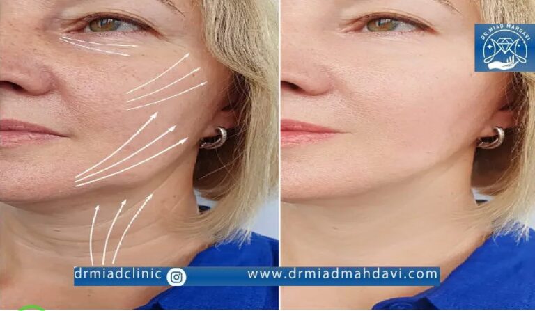 مزایای لیفت با نخ در کلینیک زیبایی دکتر میعاد مهدوی