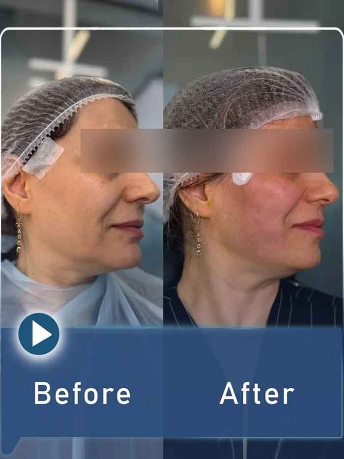 بهترین دکتر لیفت صورت با نخ تهران 2 face lift with namica thread b a