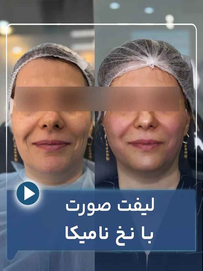 بهترین دکتر لیفت صورت با نخ تهران 1 لیفت صورت با نخ نامیکا توسط بهترین دکتر لیفت صورت با نخ تهران