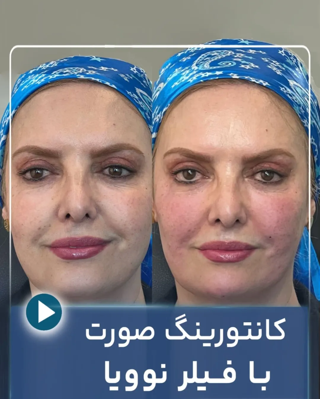 کانتورینگ صورت با فیلر نوویا