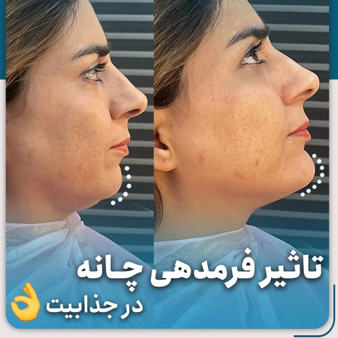 تزریق فیلر چانه 1 عکس قبل و بعد تزریق فیلر چانه | دکتر میعاد مهدوی