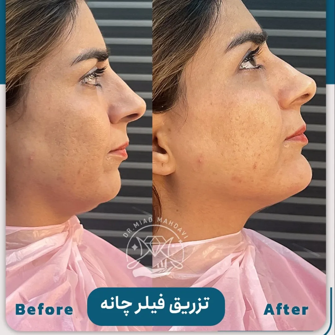 تزریق فیلر چانه 2 عکس قبل و بعد تزریق فیلر چانه | دکتر میعاد مهدوی