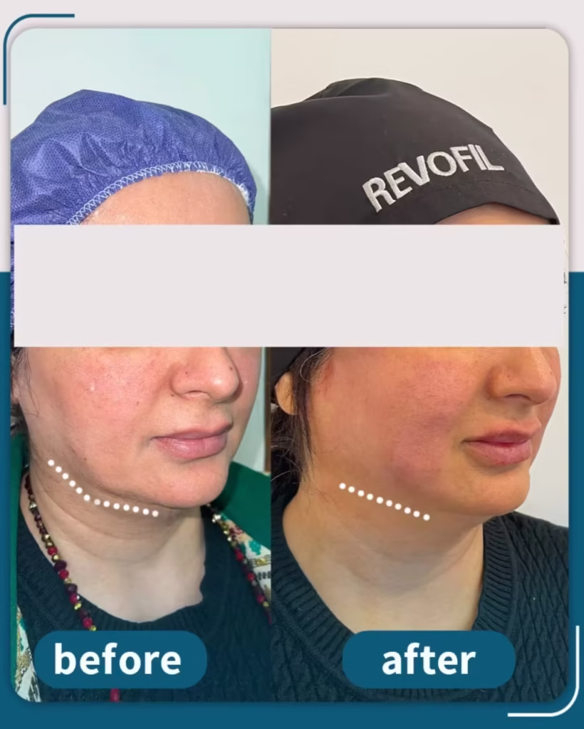 عکس قبل و بعد لیفت صورت با نخ اپتوس و تزریق فیلر لب