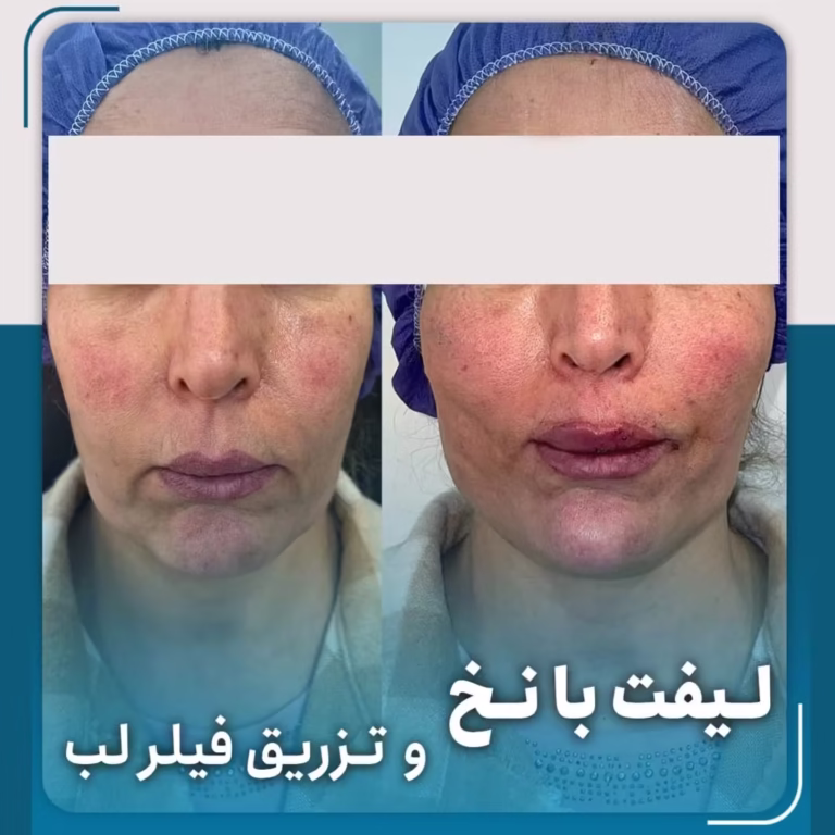 عکس قبل وبعد لیفت صورت با نخ اپتوس و تزریق فیلر لب