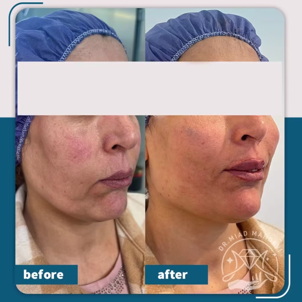 عکس قبل وبعد لیفت صورت با نخ اپتوس و تزریق فیلر لب