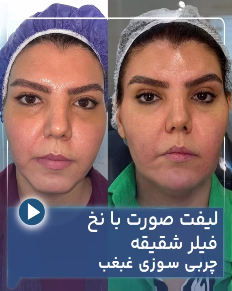 عکس قبل و بعد لیفت صورت با نخ اپتوس و تزریق فیلر شقیقه و چربی سوزی غبغب