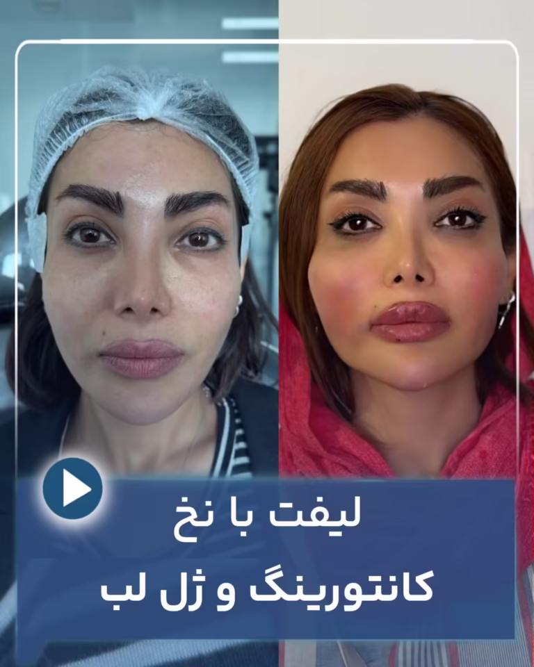 عکس قبل و بعد لیفت صورت با نخ، کانتورینگ و ژل لب