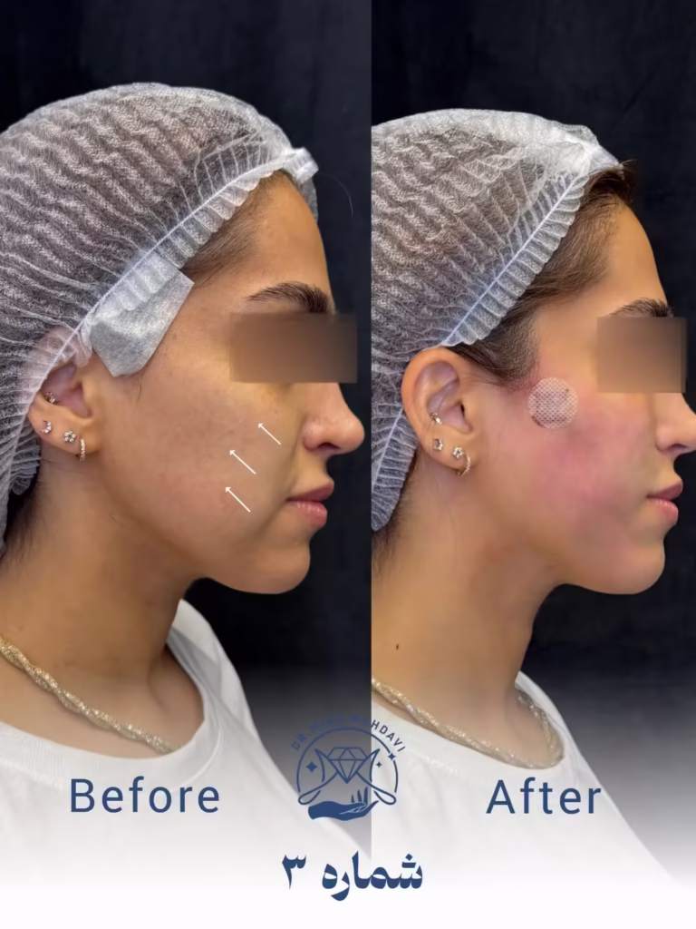 عکس قبل و بعد لیفت صورت با نخ 01