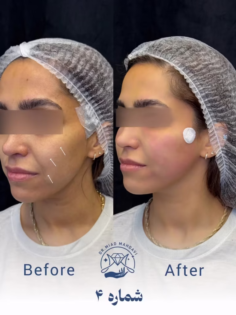 عکس قبل و بعد لیفت صورت با نخ 01