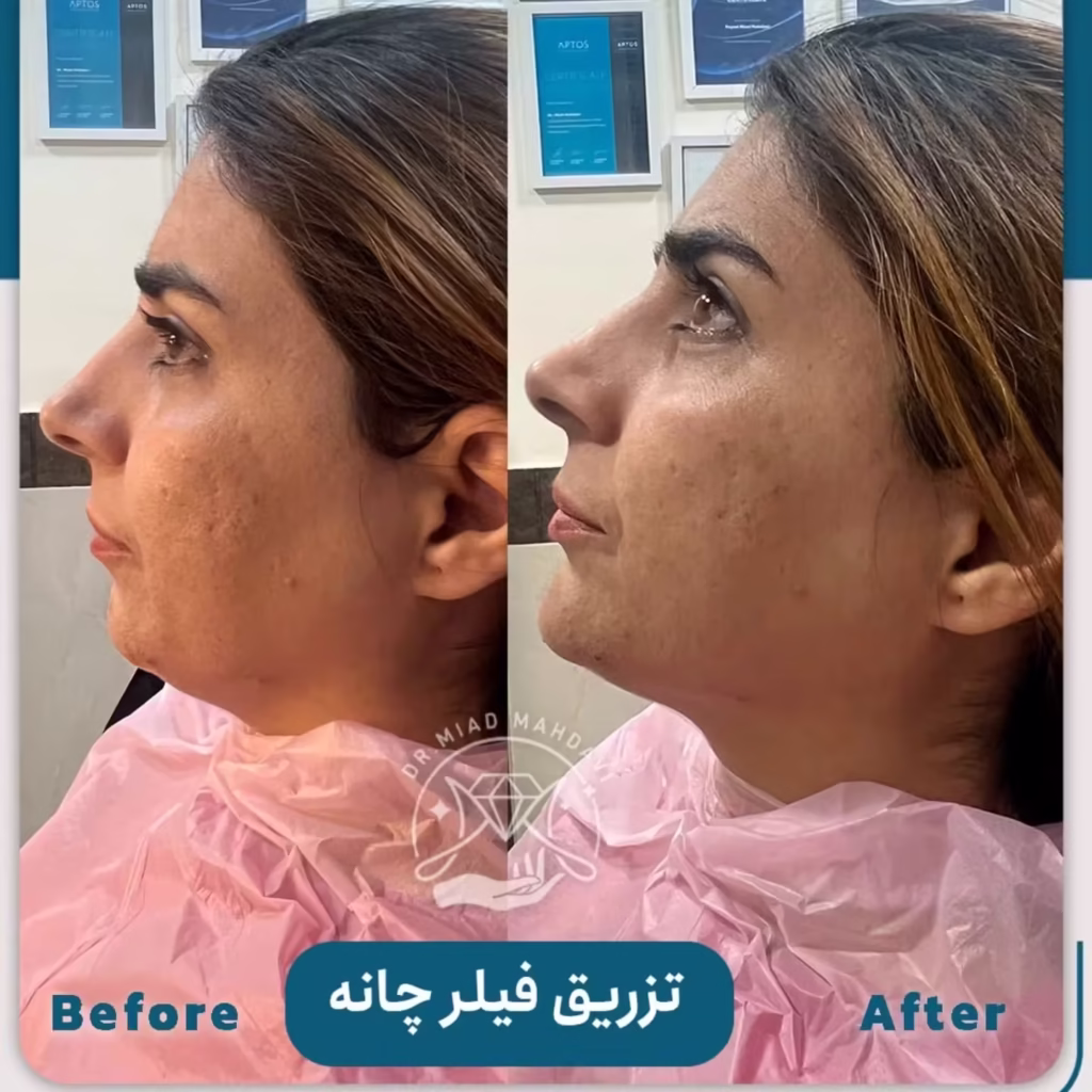 عکس قبل و بعد تزریق فیلر چانه