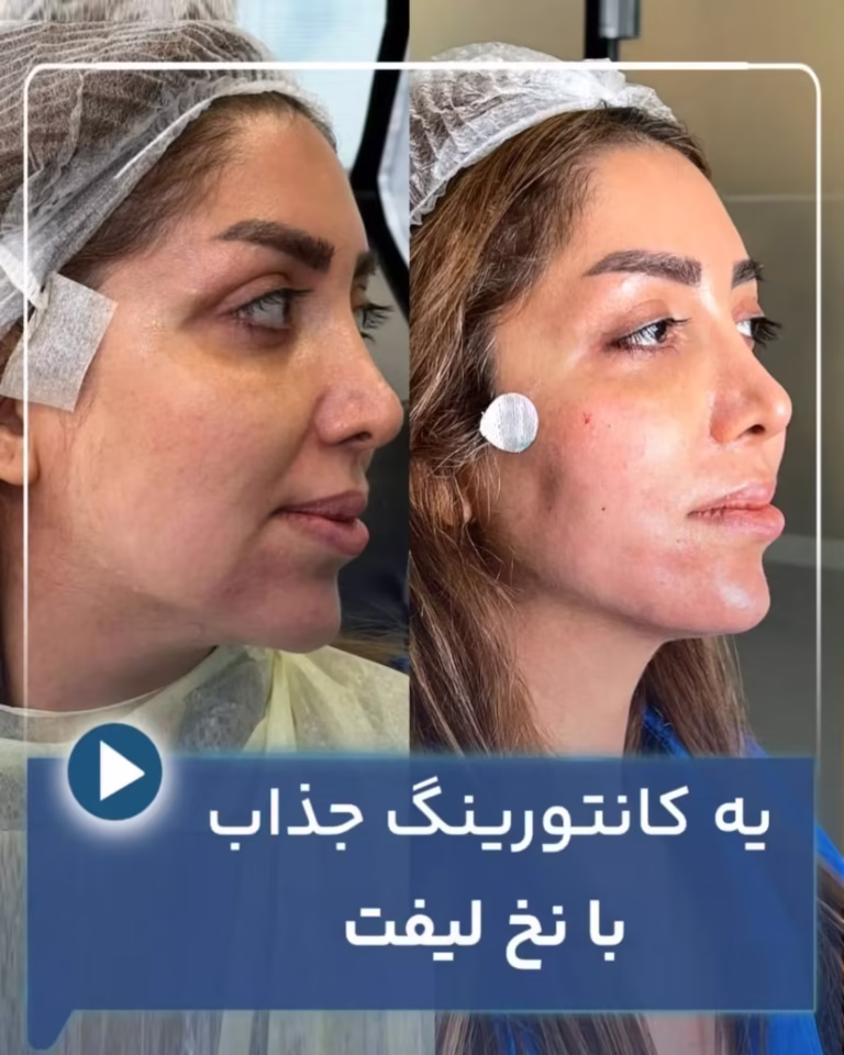 عکس قبل و بعد کانتورینگ صورت با نخ لیفت