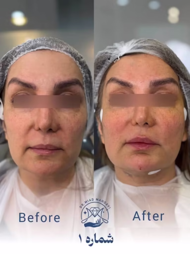 عکس قبل و بعد لیفت با نخ فیلر لب و چانه