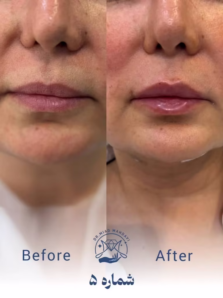 عکس قبل و بعد لیفت با نخ فیلر لب و چانه