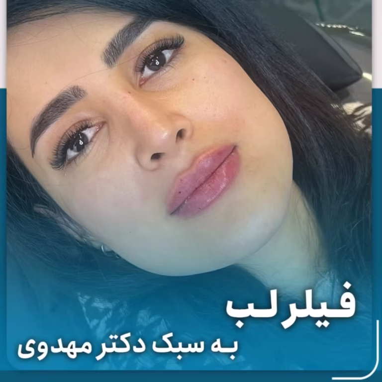 عکس قبل و بعد تزریق فیلر لب به سبک دکتر میعاد مهدوی
