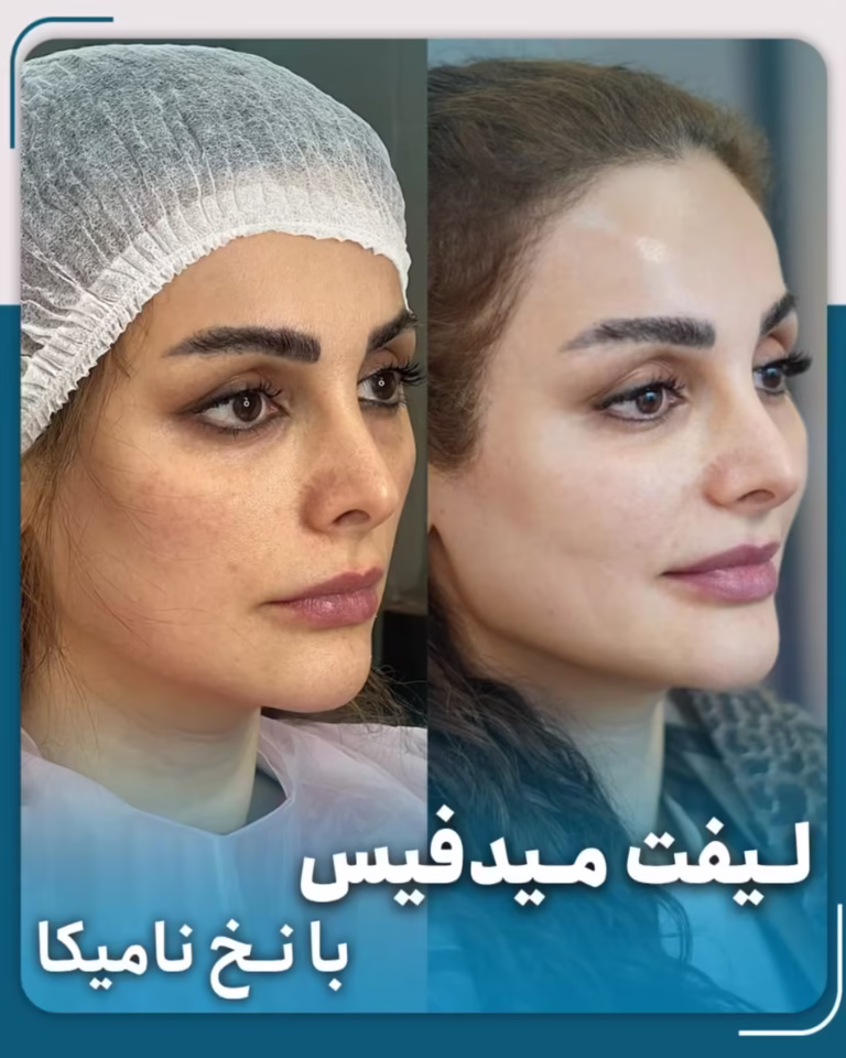 عکس قبل و بعد لیفت صورت با نخ نامیکا اپتوس